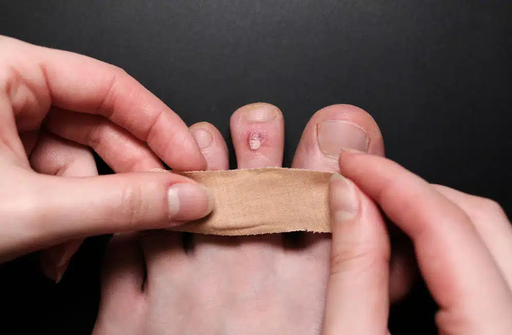 Painful Corns and Thickened Discoloured Nails: Seeking Relief from Common Foot Afflictions