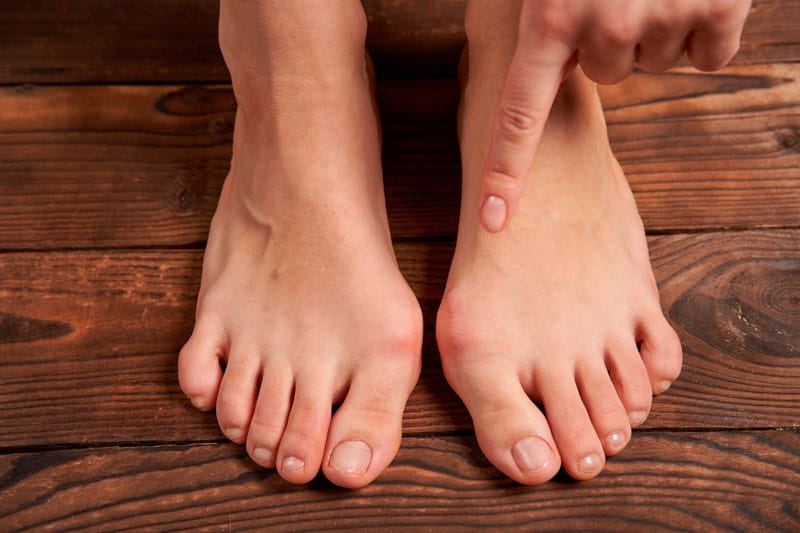 Are your Bunions a problem?