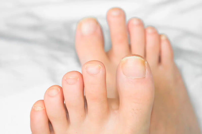 Say Goodbye to Fungal Nail Infections