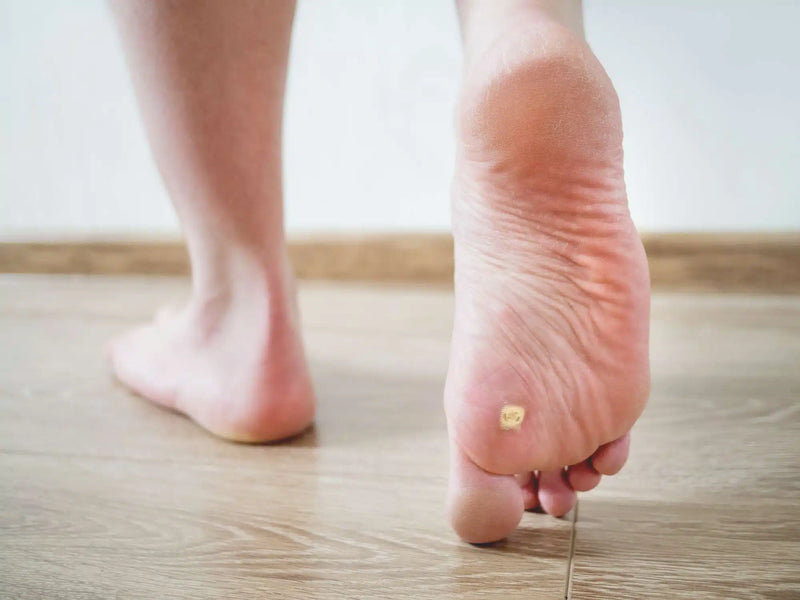 Banishing Verrucae / Plantar Warts: Step Right Clinic’s Guide to Clear Skin