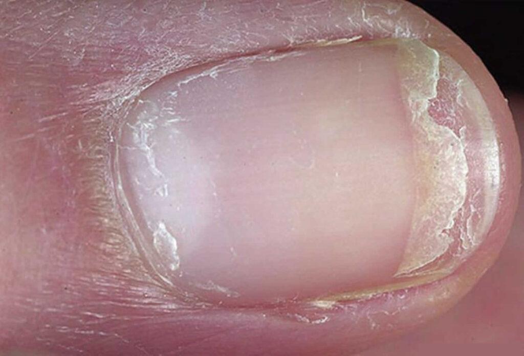Why Do My Nails Keep Splitting and Peeling? How to Strengthen Brittle Nails