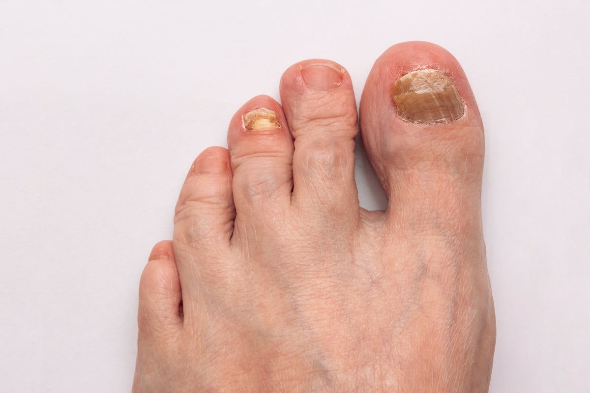 Why Is My Fungal Nail Infection Not Going Away? 7 Reasons Your Toenail Fungus Keeps Coming Back
