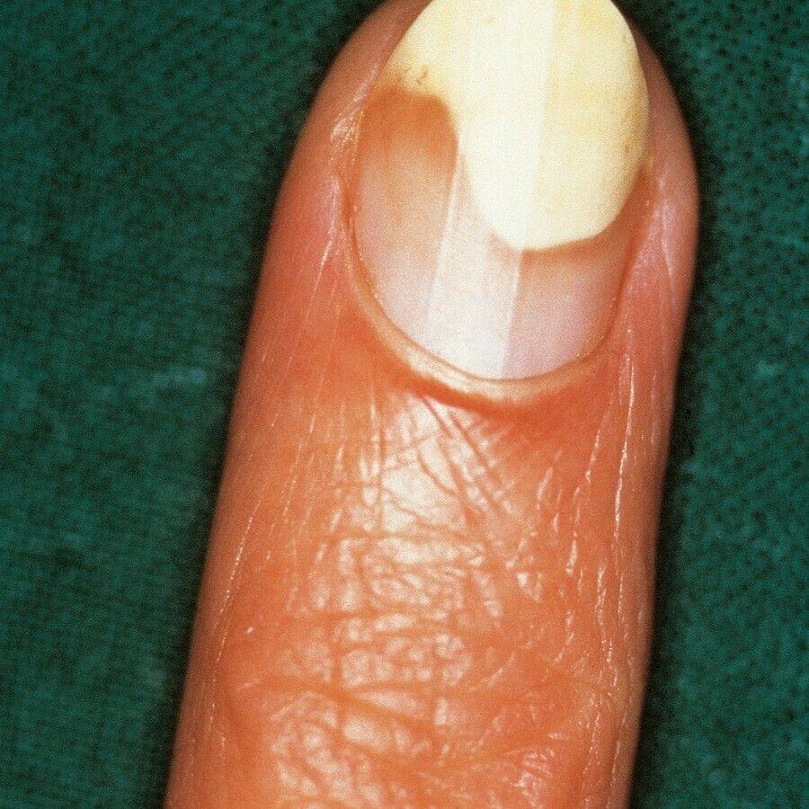 Why Is My Nail Lifting? Nail Separation (Onycholysis): Causes, Care and Recovery